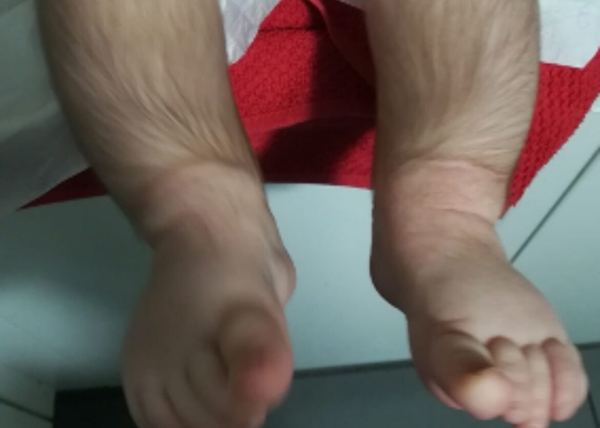 weerwolfsyndroom, hypertrichose